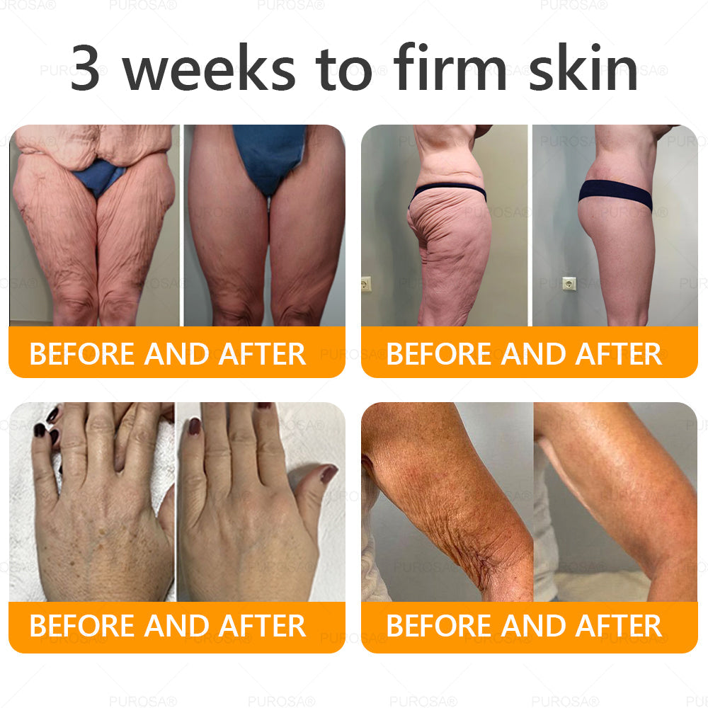 PUROSA® Bee Venom Multi-Action Cream 🐝🔥 LAST DAY — 80% OFF!A powerful anti-aging solution that targets:Deep wrinkles\Fine lines\Sagging skin\Uneven tone\Dryness
